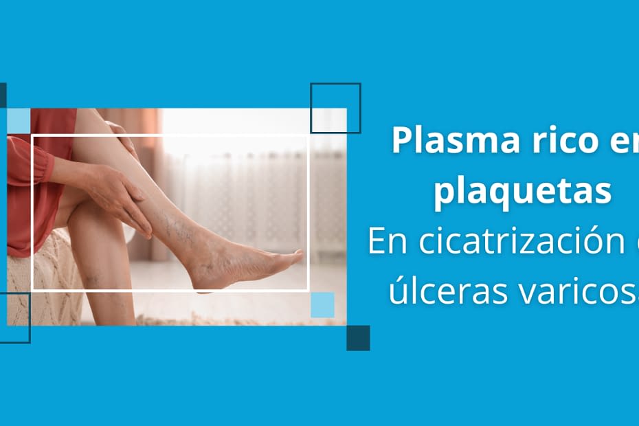 PRP en la cicatrización de úlceras varicosas