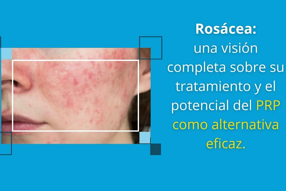 plasma rico en plaquetas para el tratamiento de la rosácea