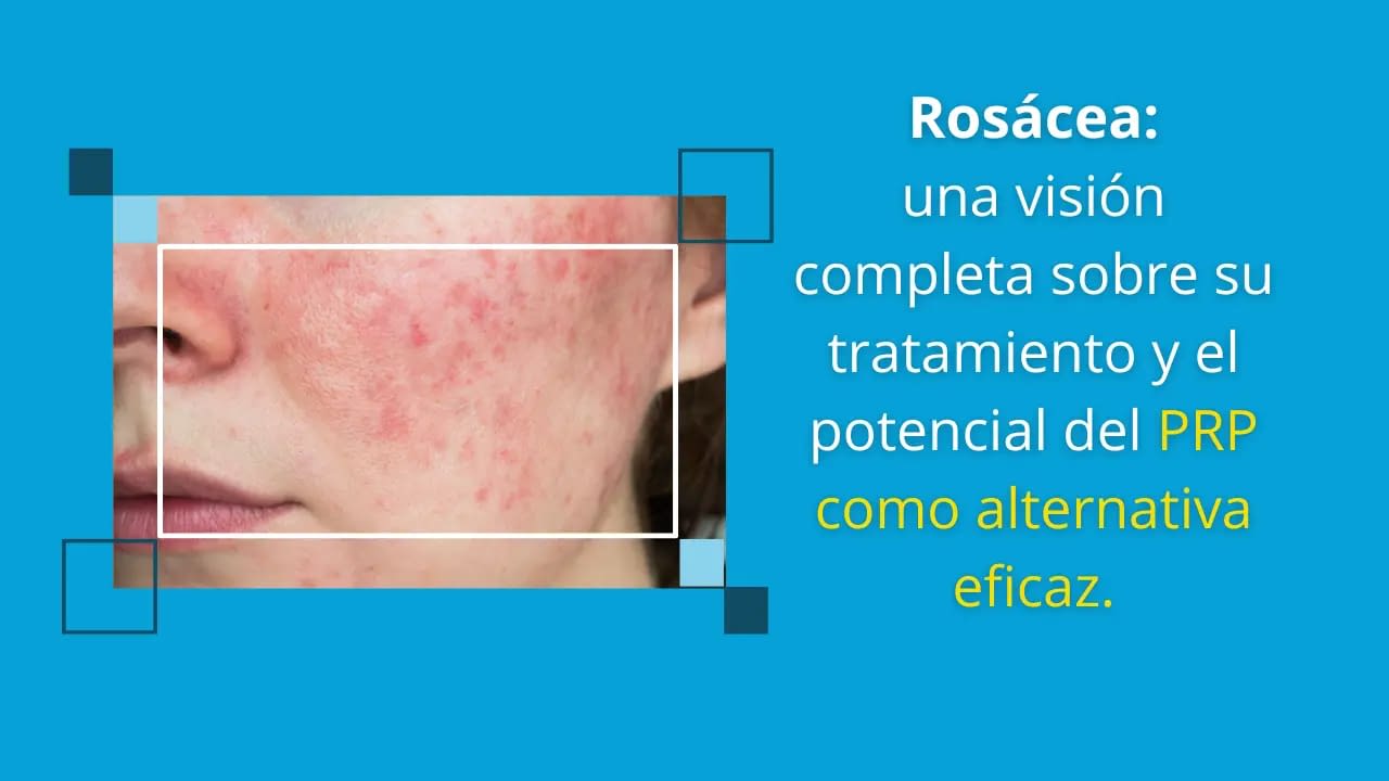 plasma rico en plaquetas para el tratamiento de la rosácea