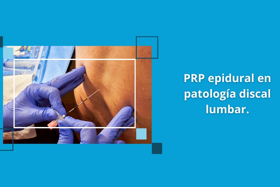 PRP epidural en patología discal lumbar