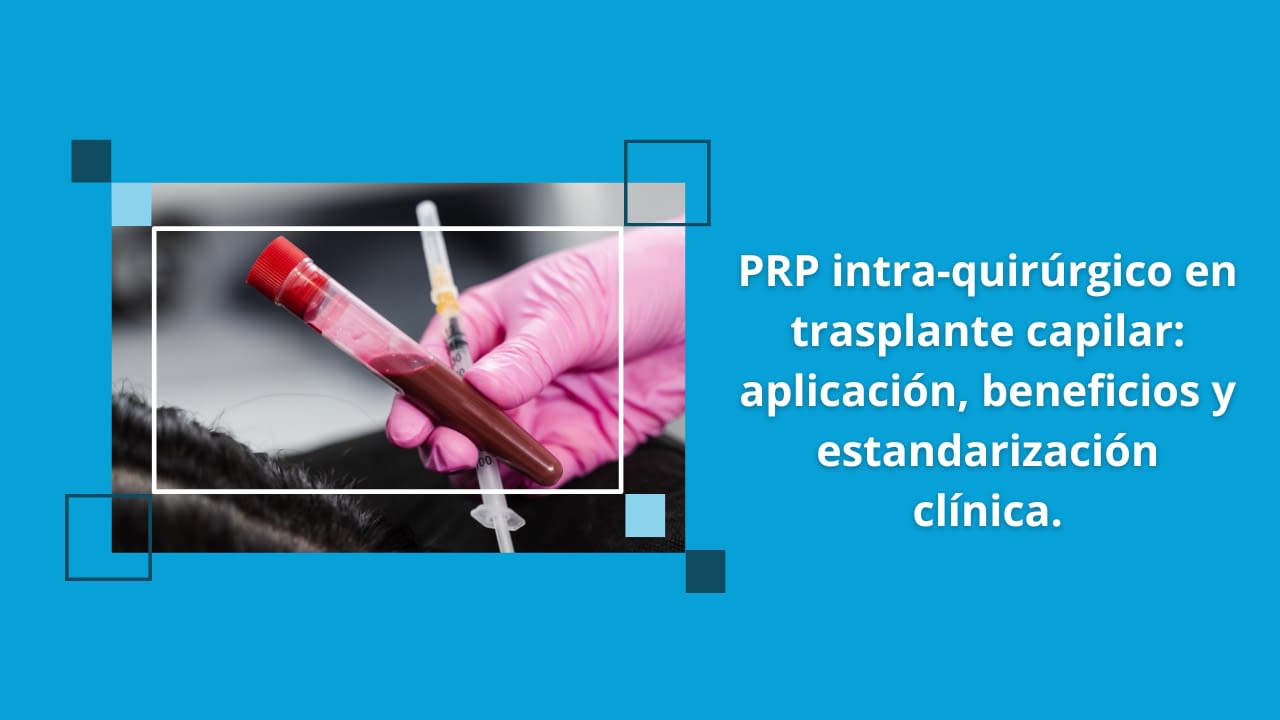 PRP intra-quirúrgico en trasplante capilar: aplicación, beneficios y estandarización clínica