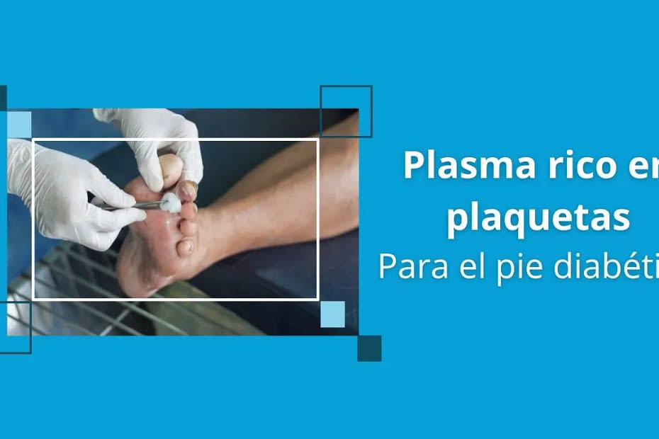 plasma rico en plaquetas para el pie diabetico