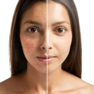 KIT PRP, PLASMA RICO EN PLAQUETAS PARA REJUVENECIMEINTO Y REGENERACION FACIAL​